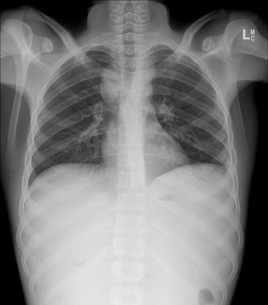 Burkitt's lymphoma | Radiology Case | Radiopaedia.org