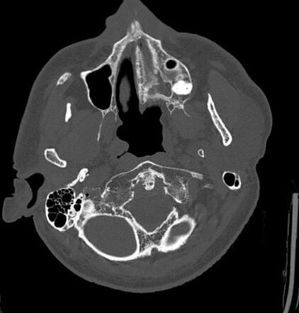 Atlanto-occipital assimilation | Radiology Case | Radiopaedia.org