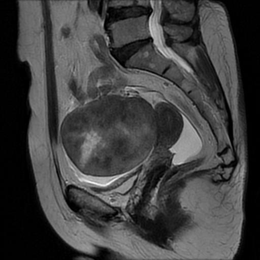 Ovarian fibrothecoma | Image | Radiopaedia.org