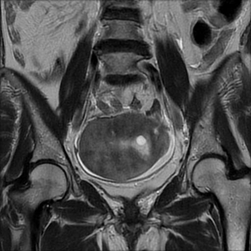 Ovarian fibrothecoma | Image | Radiopaedia.org