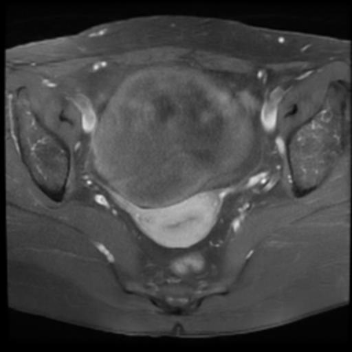 Ovarian Fibrothecoma Image