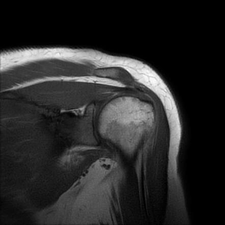 Intramuscular hemangioma | Image | Radiopaedia.org