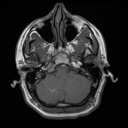 Venous infarct | Radiology Case | Radiopaedia.org