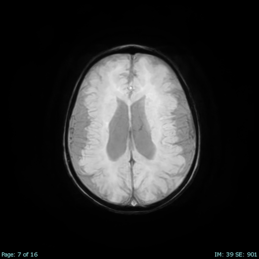 Bilateral perisylvian polymicrogyria | Image | Radiopaedia.org