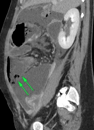 Cecal perforation following cesarean section with generalized ...