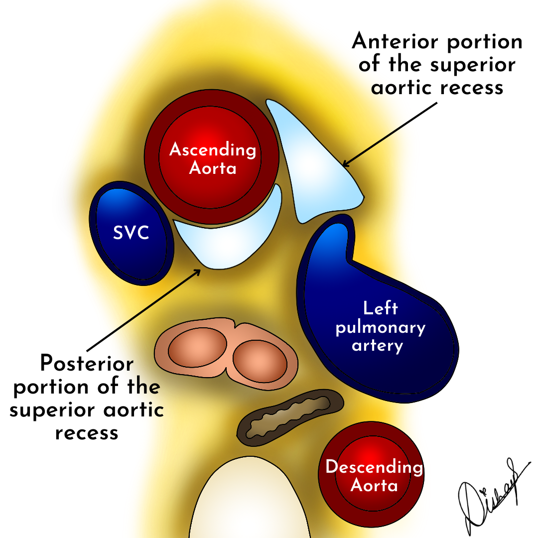 Pericardial recesses | Image | Radiopaedia.org