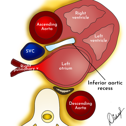 Inferior aortic recess | Radiology Reference Article | Radiopaedia.org