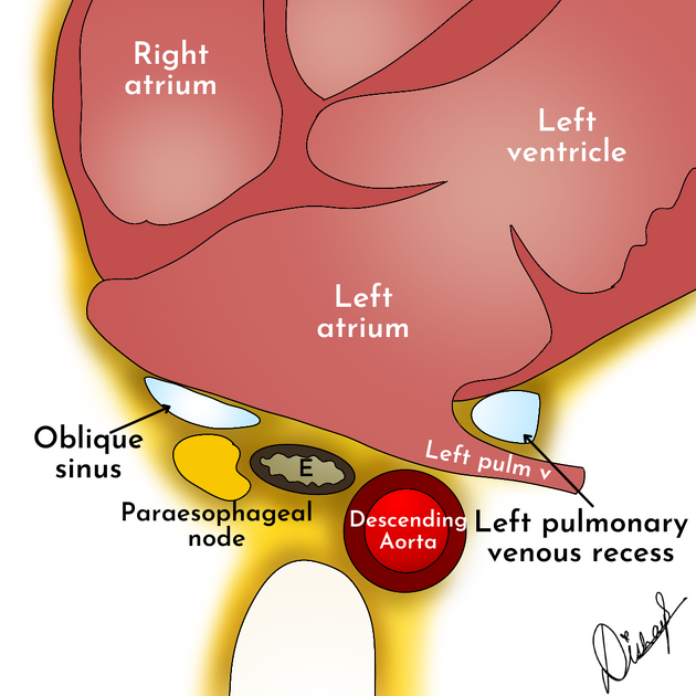 Left pulmonary venous recess | Radiology Reference Article ...