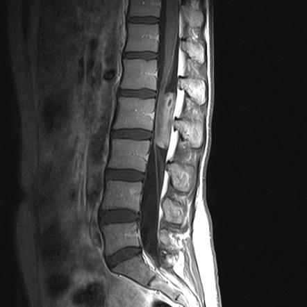 Spinal ependymoma | Radiology Case | Radiopaedia.org