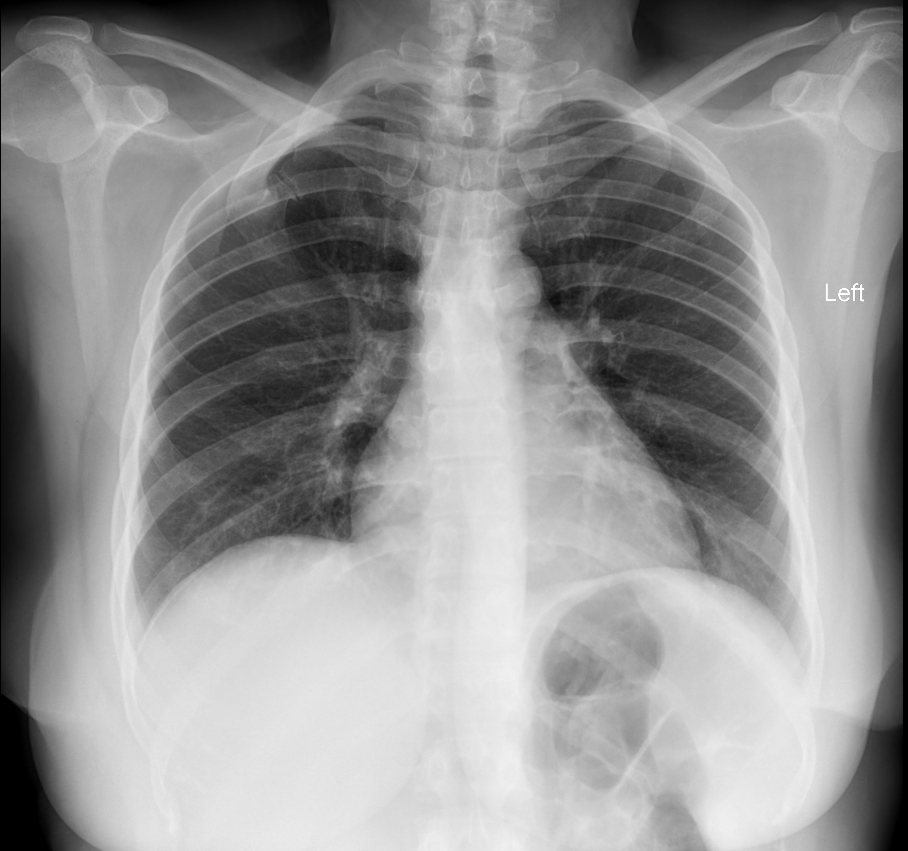 Congenital rib fusion with pseudo articulation | Image | Radiopaedia.org