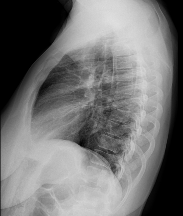 Congenital rib fusion with pseudo articulation | Image | Radiopaedia.org