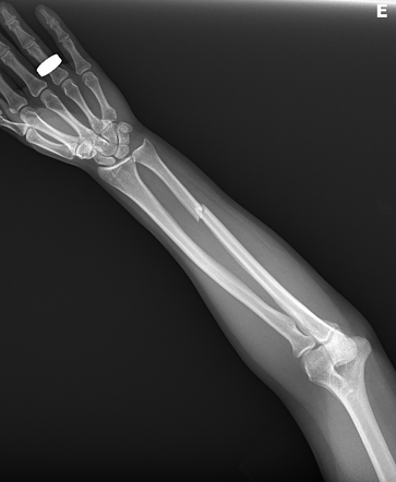 Isolated Ulnar Shaft Fracture Radiology Case Radiopaedia Org