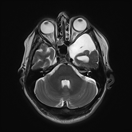 Arachnoid cyst causing proptosis | Radiology Case | Radiopaedia.org