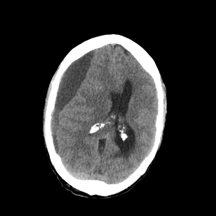 Subdural drain | Radiology Case | Radiopaedia.org