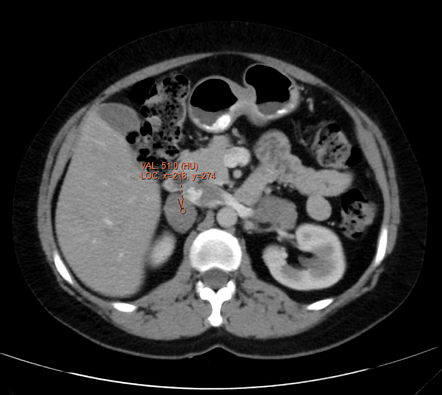 Bilateral macronodular adrenal cortical hyperplasia | Image ...