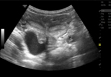 Uterus Didelphys With An Obstructed Hemivagina And Ipsilateral Renal ...