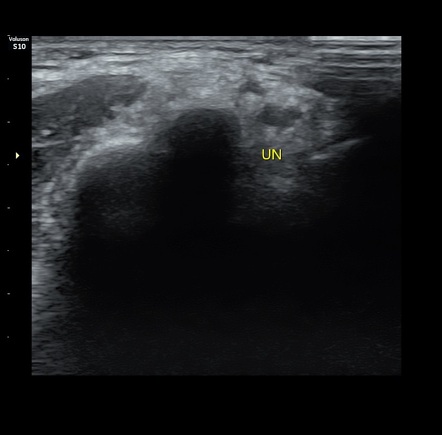 Snapping triceps syndrome with ulnar nerve dislocation | Radiology Case ...