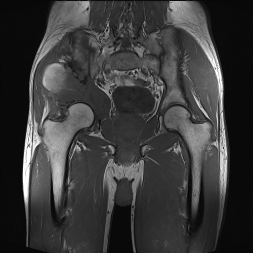 Iliac chondrosarcoma | Image | Radiopaedia.org