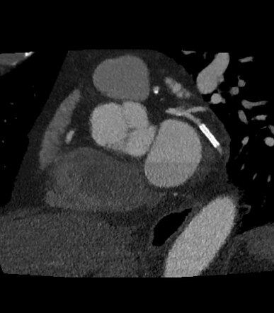 Coronary Artery Disease - Reporting And Data System 