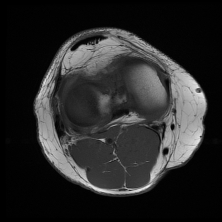 Full-thickness ACL tear | Image | Radiopaedia.org