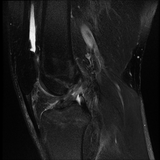 Full-thickness Acl Tear 