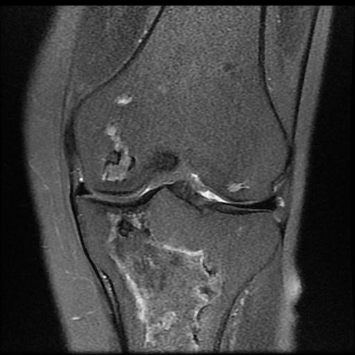 Multifocal bone infarcts - bilateral knee joints | Image | Radiopaedia.org