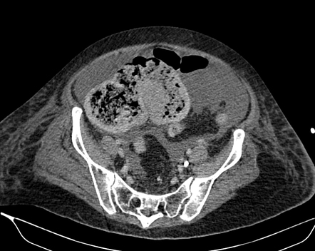 Acute pulmonary graft versus host disease and typhlitis | Radiology ...