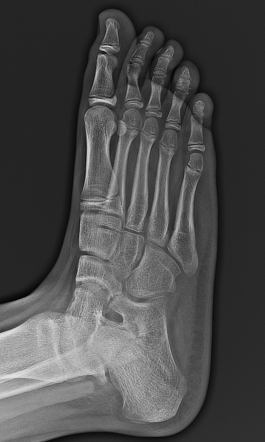 Calcaneonavicular coalition | Radiology Case | Radiopaedia.org