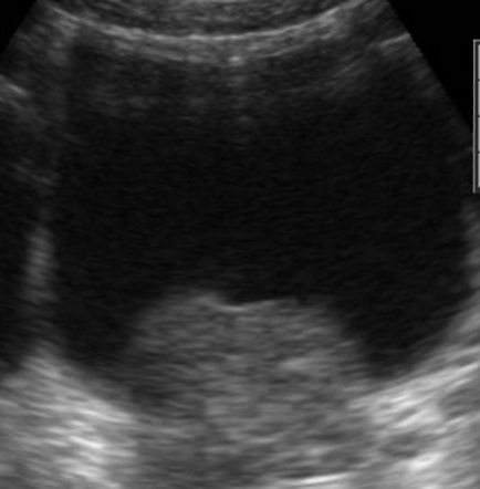 case study 55 benign prostatic hyperplasia