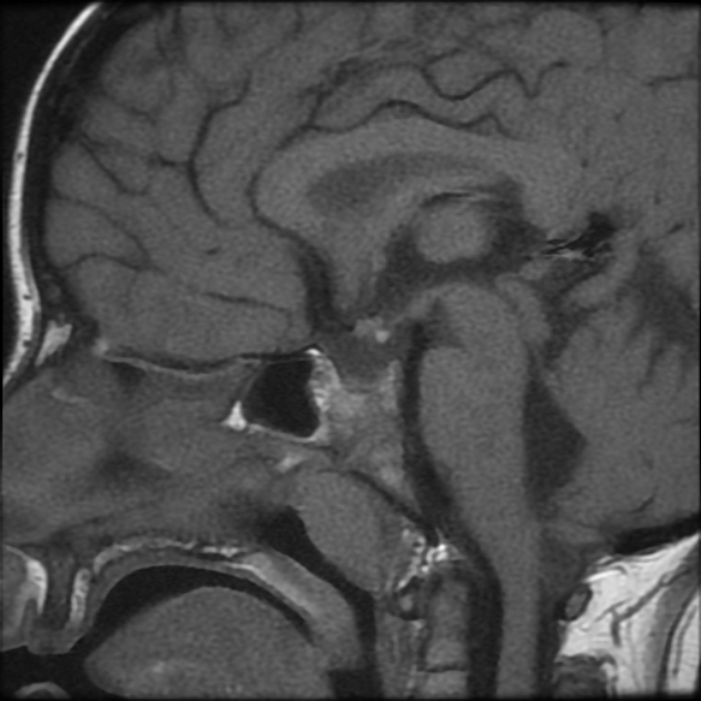 Pituitary Stalk Interruption Syndrome Image 8942