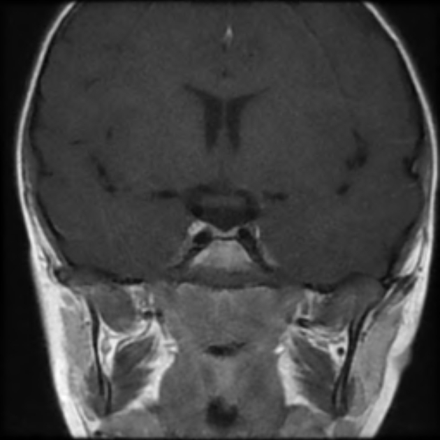 Pituitary Stalk Interruption Syndrome Image 6416