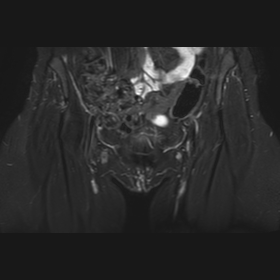 Iliopsoas Bursitis | Image | Radiopaedia.org