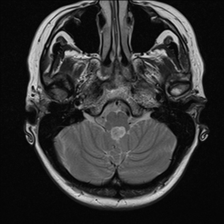 Choroid plexus papilloma and acoustic scwhannoma | Image | Radiopaedia.org