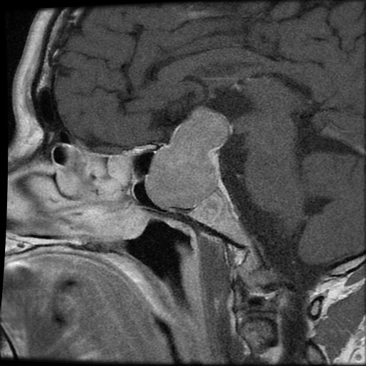 Pituitary Prolactinoma Image