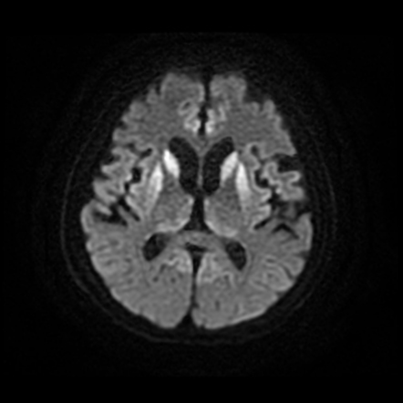 Creutzfeldt-Jakob disease | Image | Radiopaedia.org