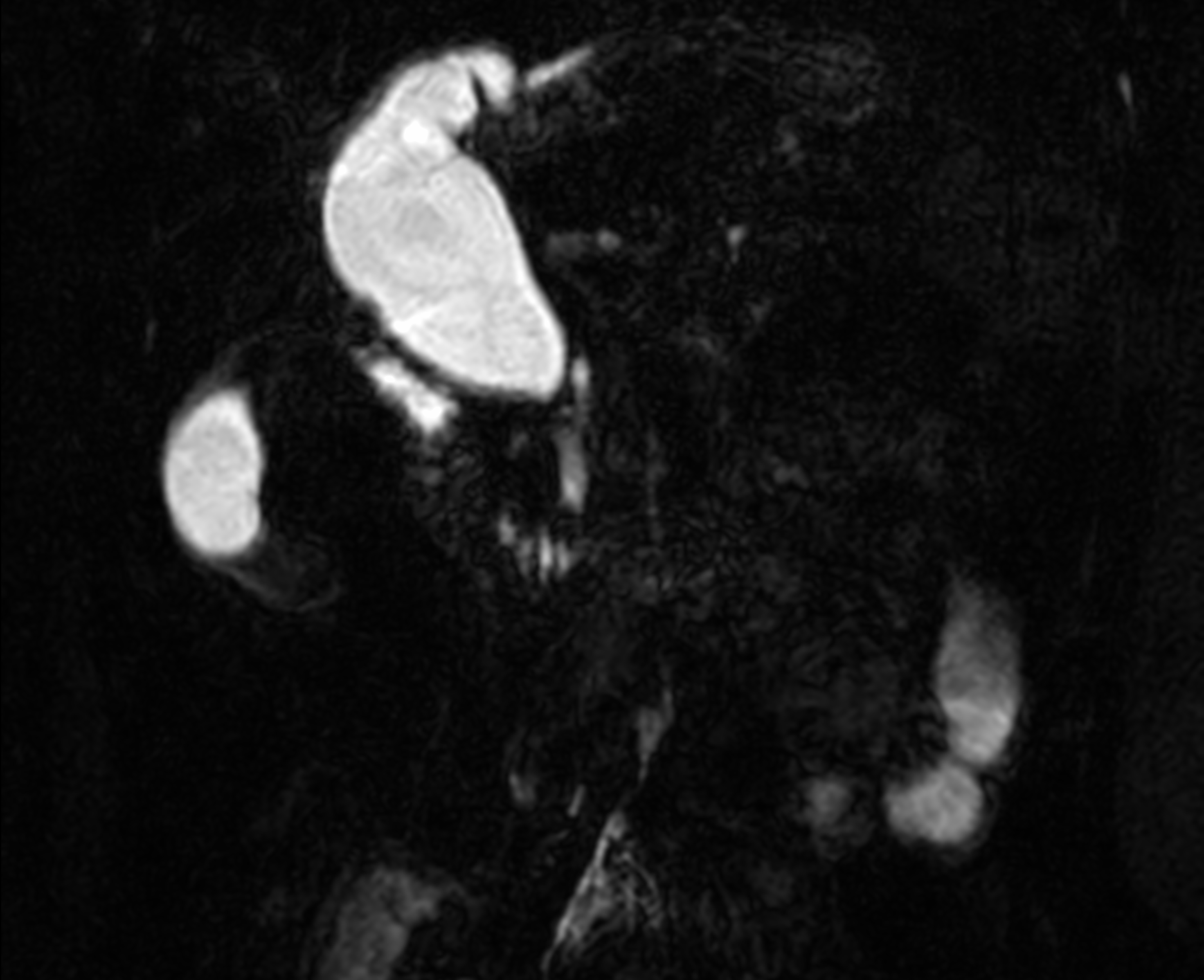 Choledochal cyst - type IVa with anomalous pancreaticobiliary junction ...