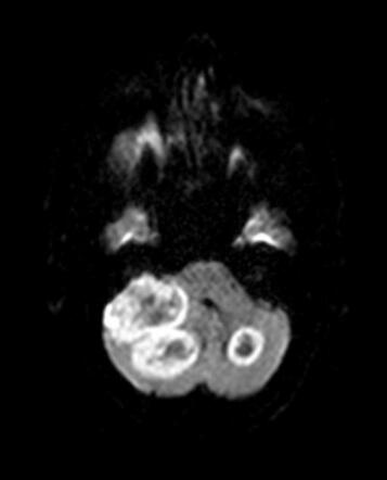 Brain Metastases From Lung Cancer | Radiology Case | Radiopaedia.org