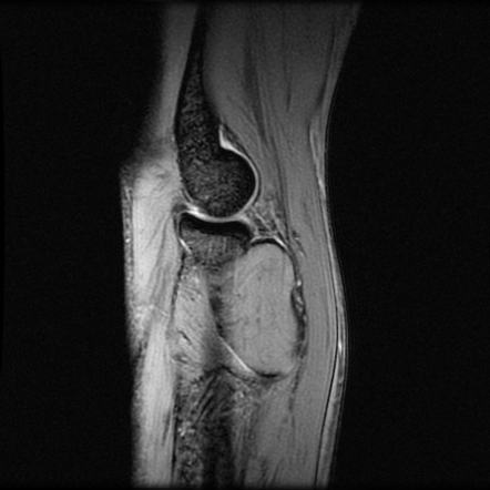 Intramuscular elbow lipoma (MRI) | Image | Radiopaedia.org