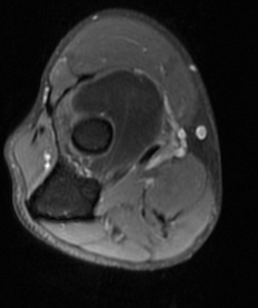 Intramuscular elbow lipoma (MRI) | Image | Radiopaedia.org