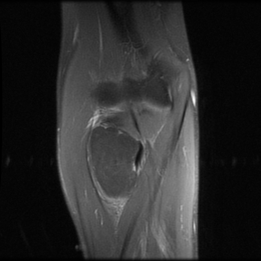 Intramuscular elbow lipoma (MRI) | Image | Radiopaedia.org