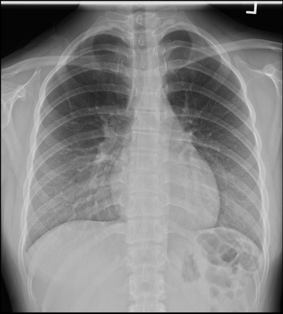 Normal pediatric chest (PA erect) | Radiology Case | Radiopaedia.org