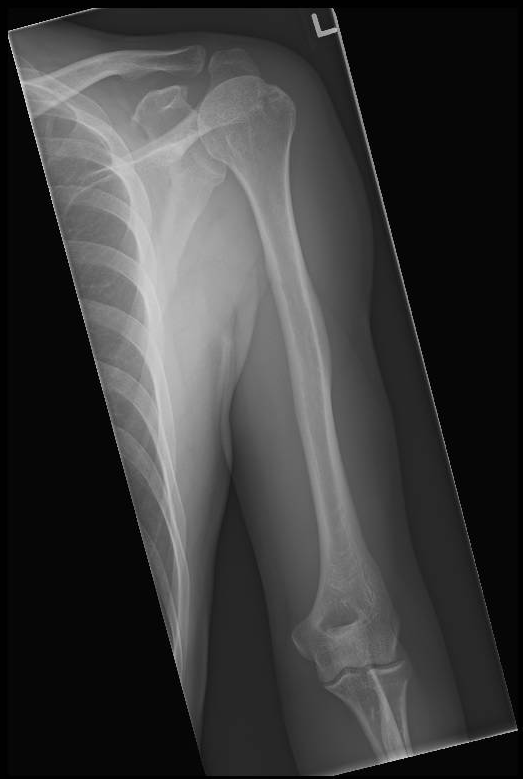 Normal humerus series | Image | Radiopaedia.org