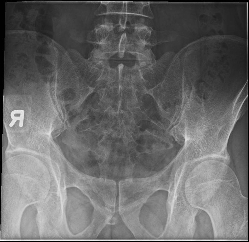 Xray Of The Sacroiliac Joint Showing Features Of Right