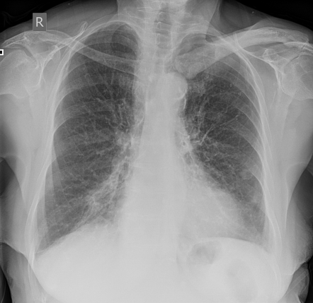 Paget disease of the clavicle | Radiology Case | Radiopaedia.org