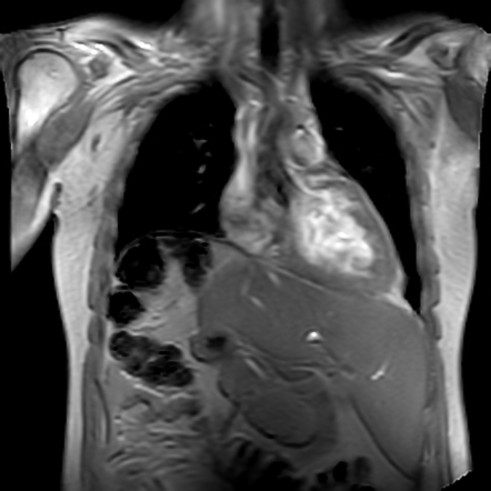 Situs inversus partialis | Radiology Case | Radiopaedia.org