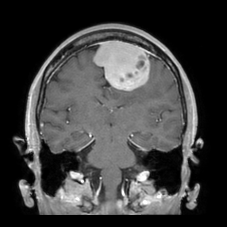 Dural solitary fibrous tumor | Image | Radiopaedia.org