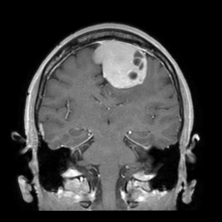 Dural solitary fibrous tumour | Radiology Case | Radiopaedia.org