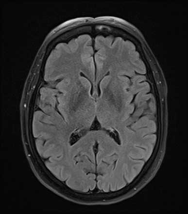 Cerebral cavernoma - recent hemorrhage and associated developmental ...