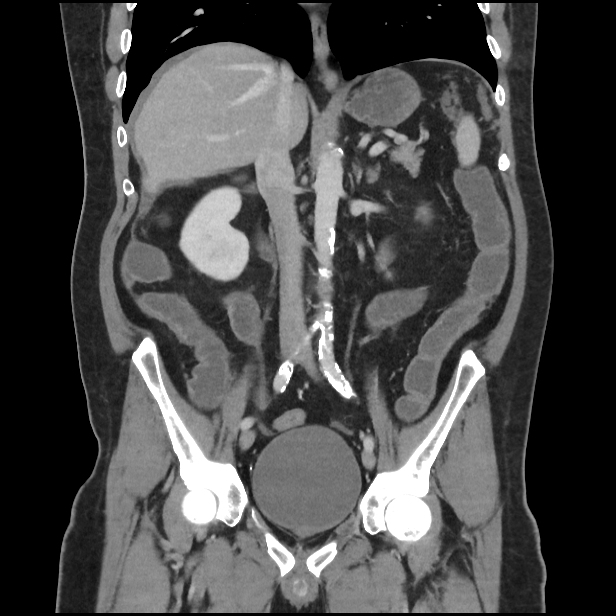 Chemotherapy-associated enterocolitis | Image | Radiopaedia.org