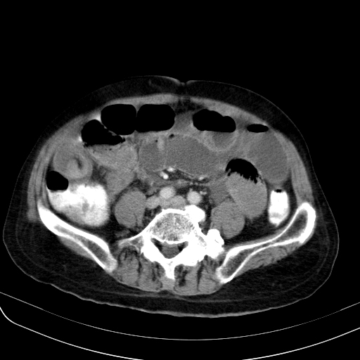 Small bowel volvulus causing small bowel obstruction, mimicking ...